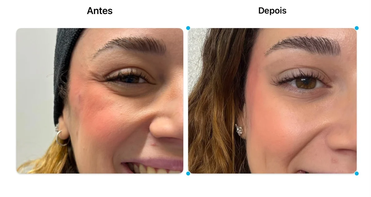 Antes e depois de cuidado facial na Atual Estética — caso 5