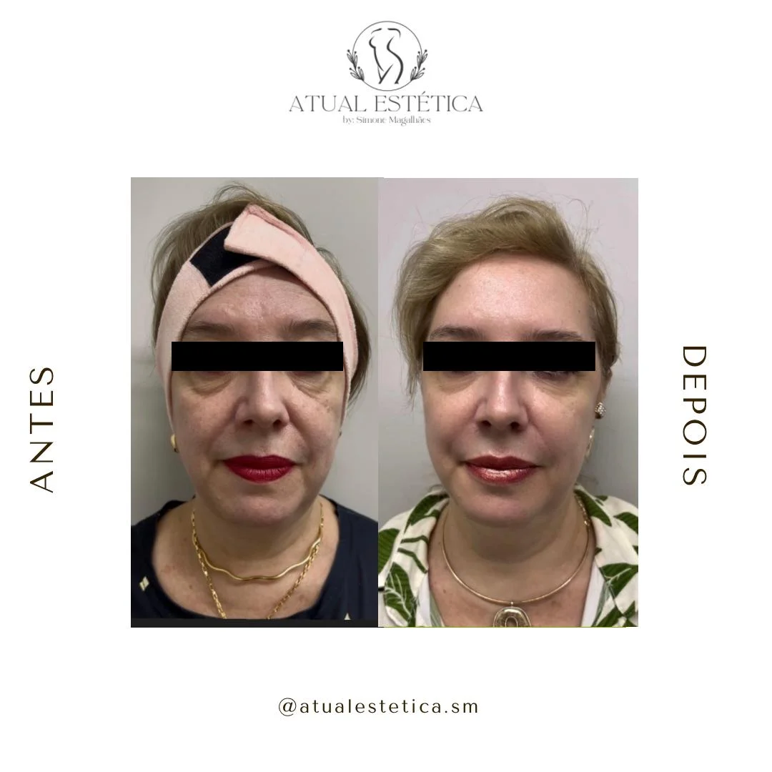 Antes e depois de cuidado facial na Atual Estética — caso 6