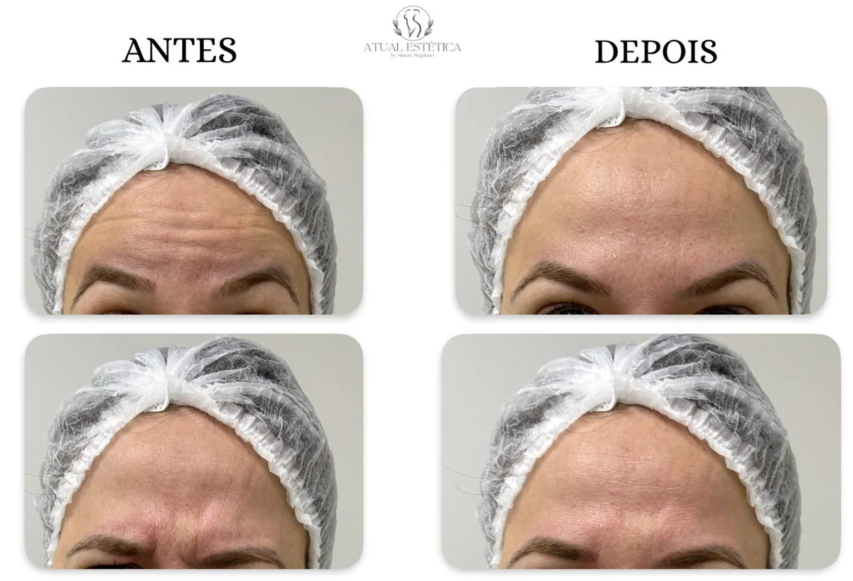 Antes e depois de cuidado facial na Atual Estética — caso 3
