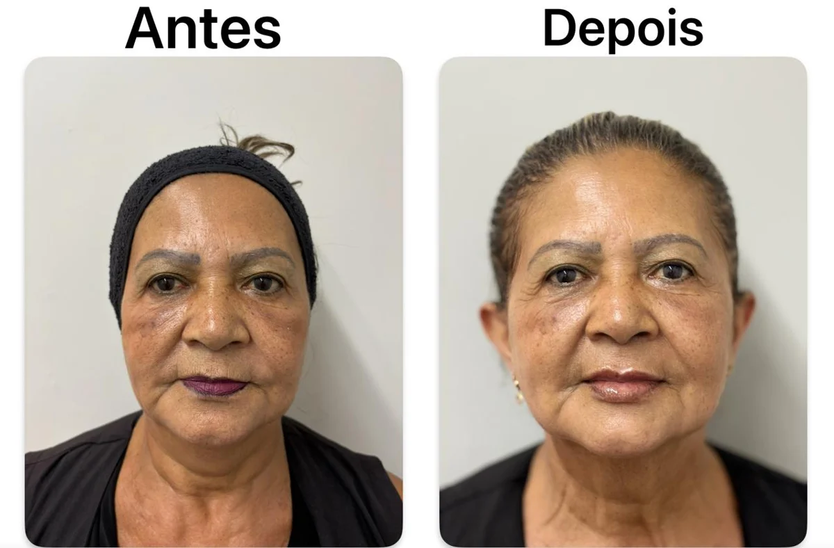 Antes e depois de cuidado facial na Atual Estética — caso 7