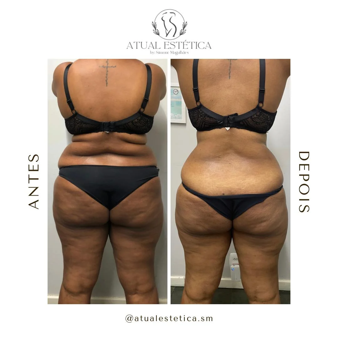 Antes e depois de cuidado corporal na Atual Estética — caso 9
