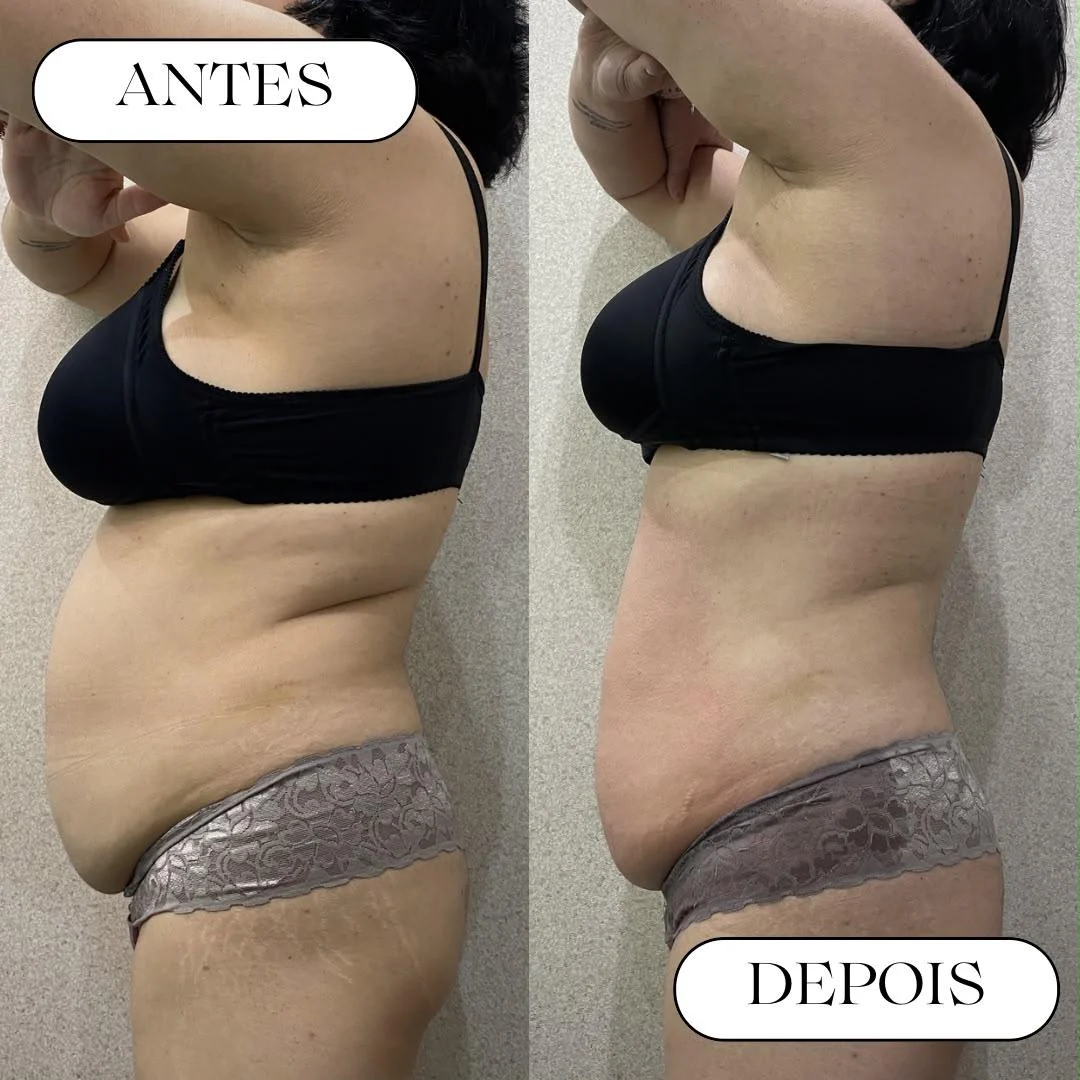 Antes e depois de cuidado corporal na Atual Estética — caso 2