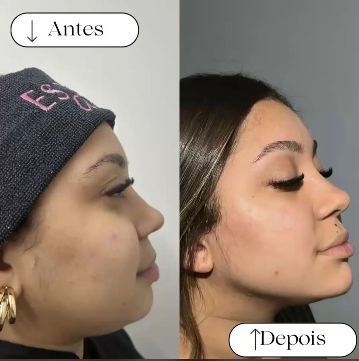 Antes e depois de cuidado facial na Atual Estética — caso 1